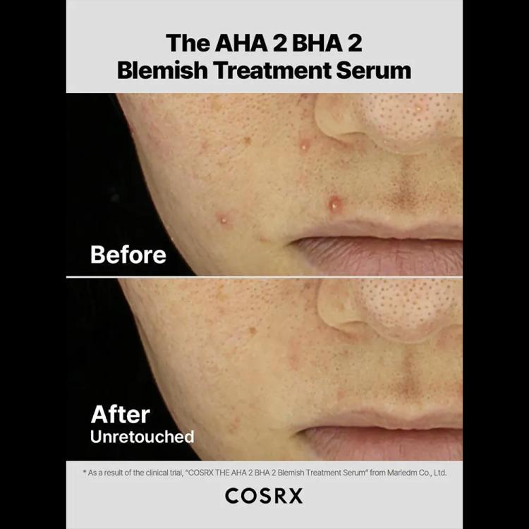 Cosrx The AHA 2 BHA 2 Blemish Treatment Serum - 50 g (30+ cotton balls per serum)