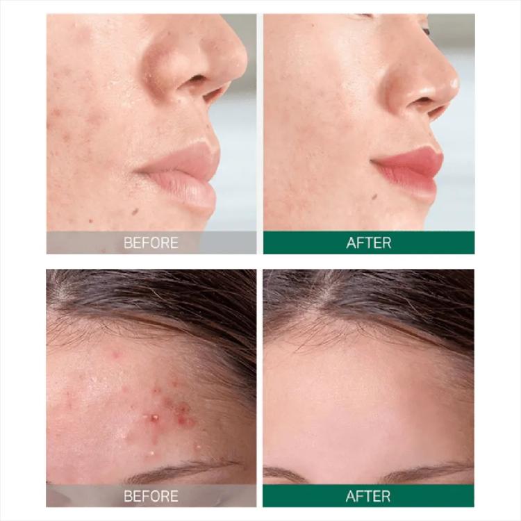 Some By Mi AHA. BHA. PHA 30 Days Miracle Starter Gift Set - (20 g + 25 g + 30 ml + 10 ml)